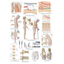 Osteoporoza - tablica anatomiczna